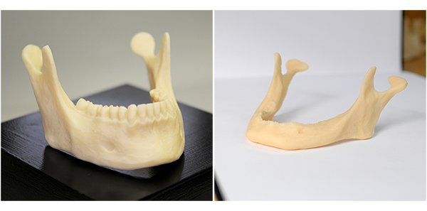 Comparison of healthy vs weak jaw bone