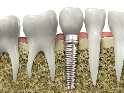 Dental implant illustration